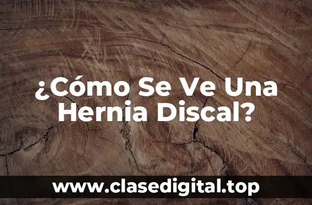 ¿Cómo Se Ve Una Hernia Discal?