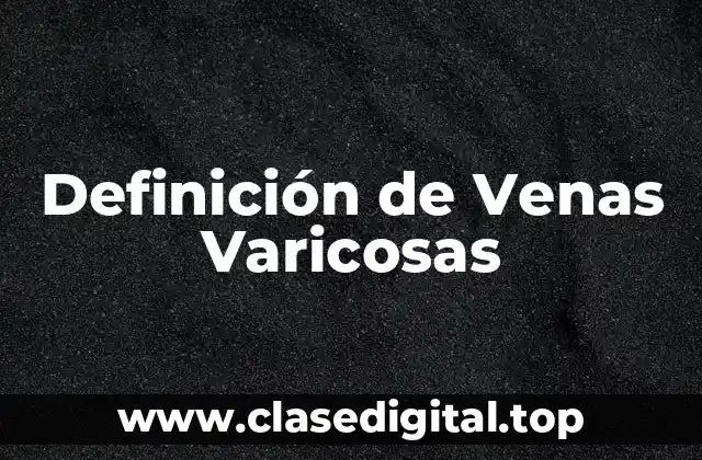 Definición de Venas Varicosas