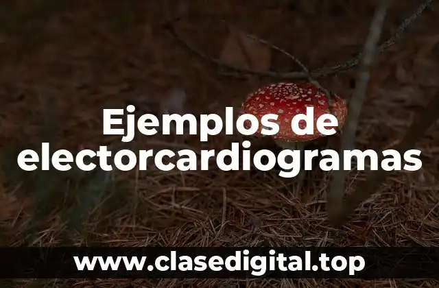 Ejemplos de electorcardiogramas