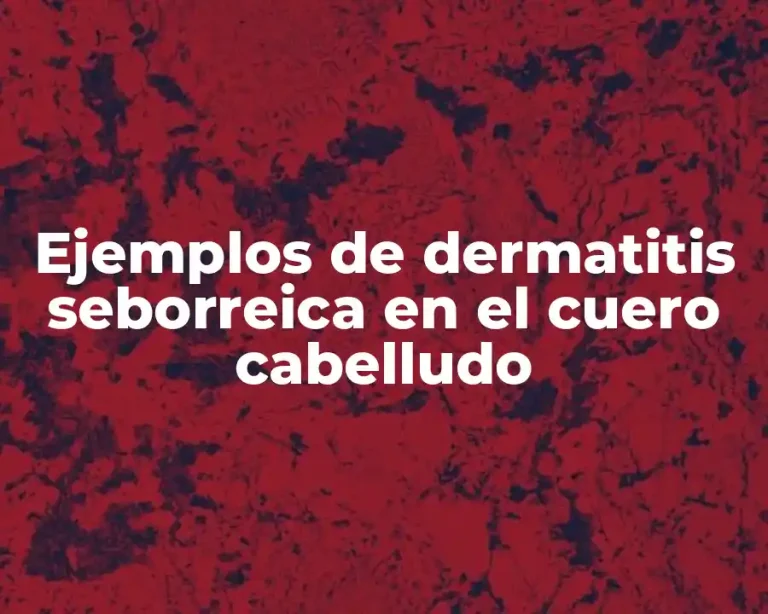 Ejemplos de dermatitis seborreica en el cuero cabelludo